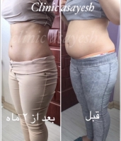 لاغری بدون جراحی با کرایولیپولیز