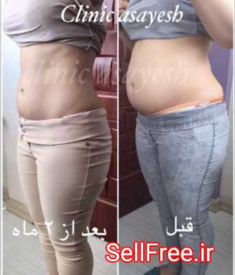 لاغری بدون جراحی با کرایولیپولیز