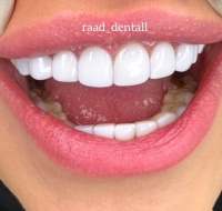 مدل کامپوزیت دندان