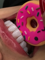 کامپوزیت زیبایی دندان