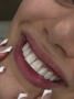 کامپوزیت زیبایی دندان