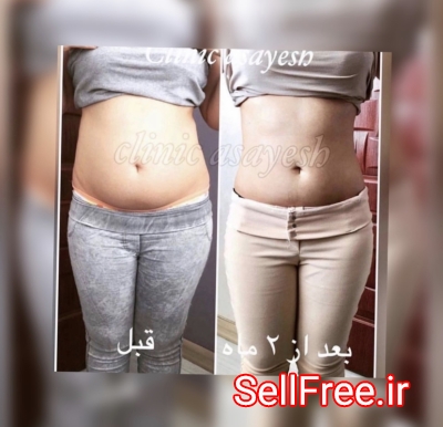 لاغری بدون جراحی با کرایولیپولیز