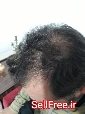کاشت مو تخصصی سر و ابرو در اردبیل