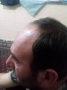 کاشت مو تخصصی سر و ابرو در اردبیل