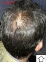 کاشت مو سر و ابرو تخصصی در اردبیل