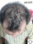 کاشت مو سر و ابرو تخصصی در اردبیل